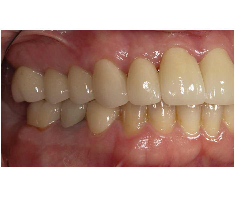 Bite Reconstruction — result