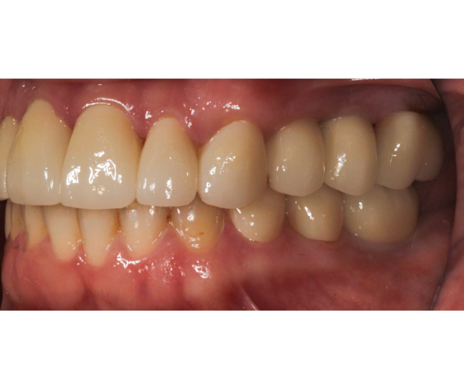 Comprehensive Bite Reconstruction, After, Right Lateral