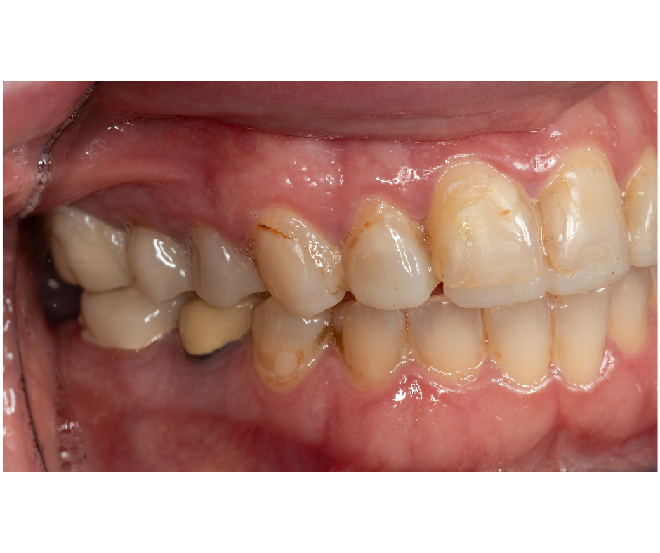 Bite Reconstruction — before treatment