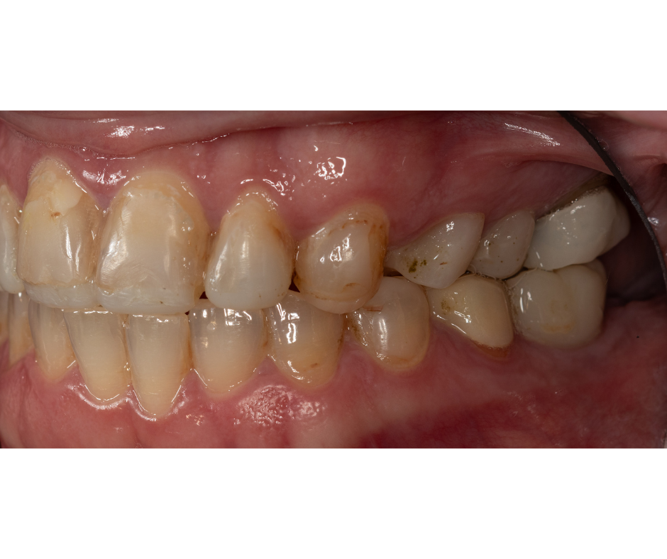 Comprehensive Bite Reconstruction, Before, Right Lateral