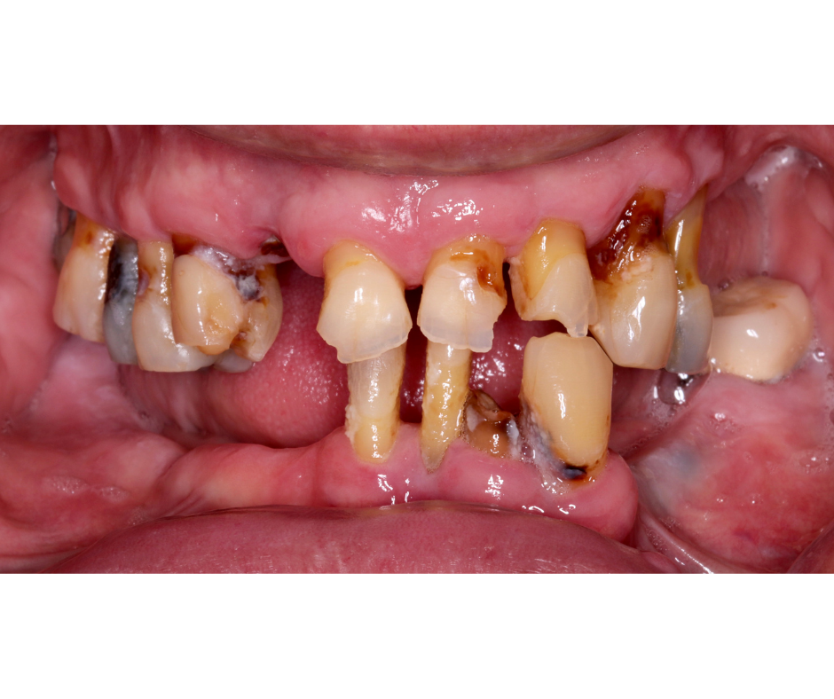 Full Arch Implants — before treatment