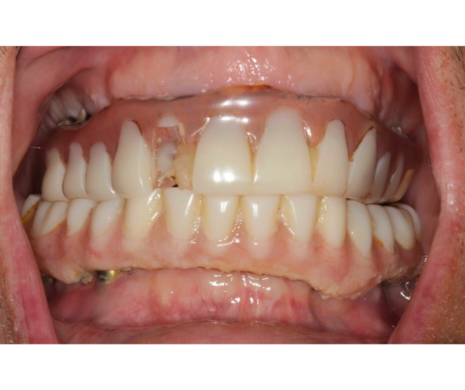 Failed Implant Correction — before treatment