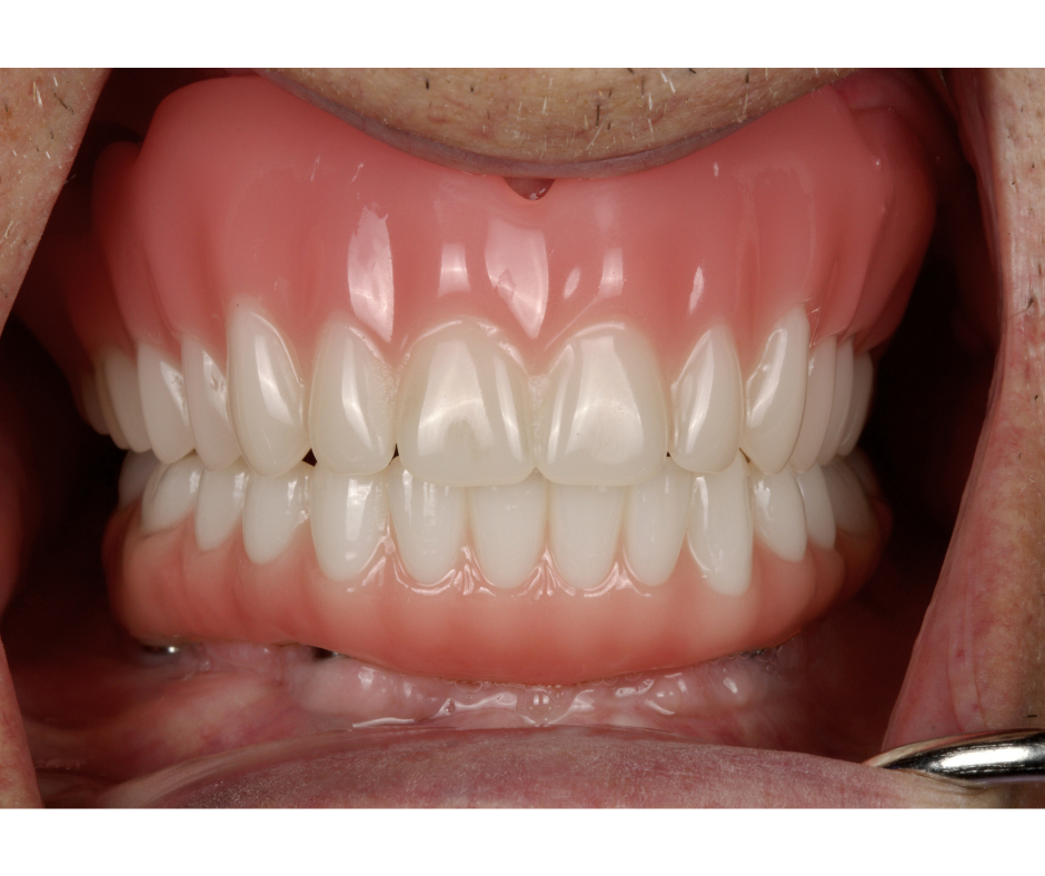 Maxillomandibular Rehab — result