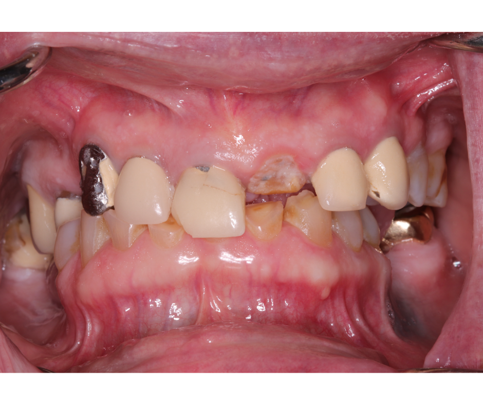 Maxillomandibular Rehab — before treatment