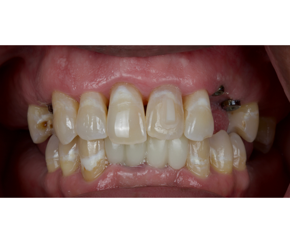Posterior Bite Collapse Rehabilitation, After