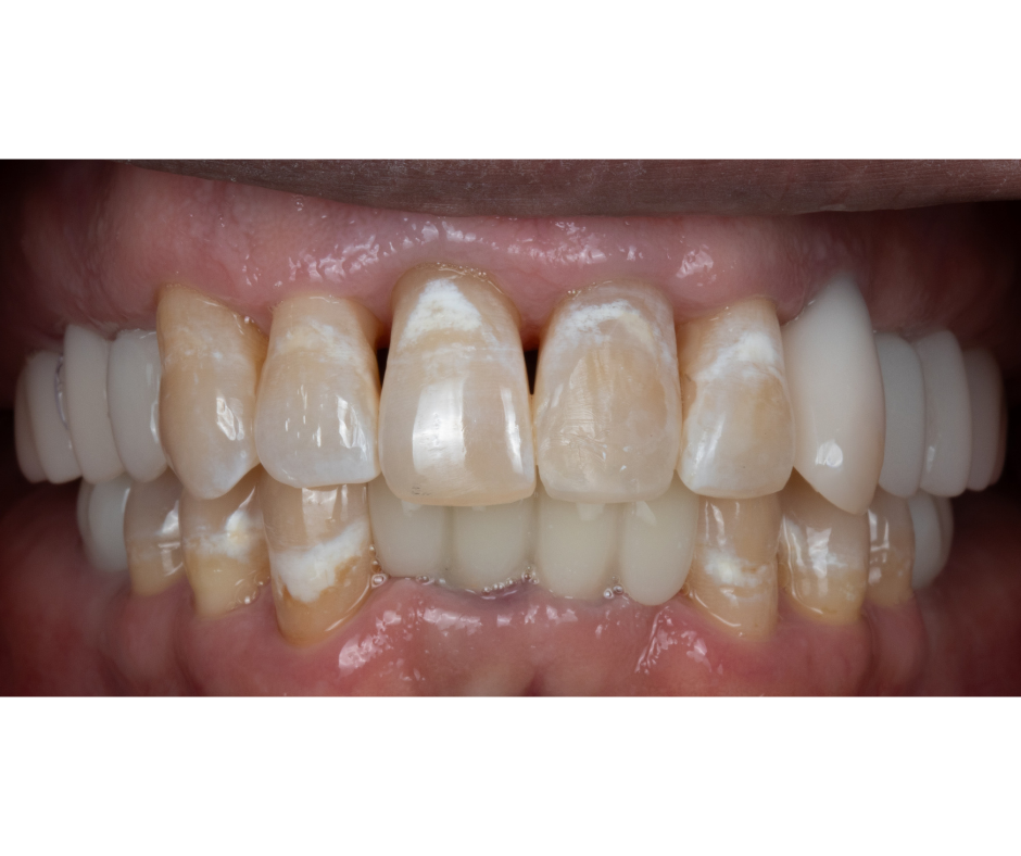 Posterior Bite Collapse Rehabilitation, Before