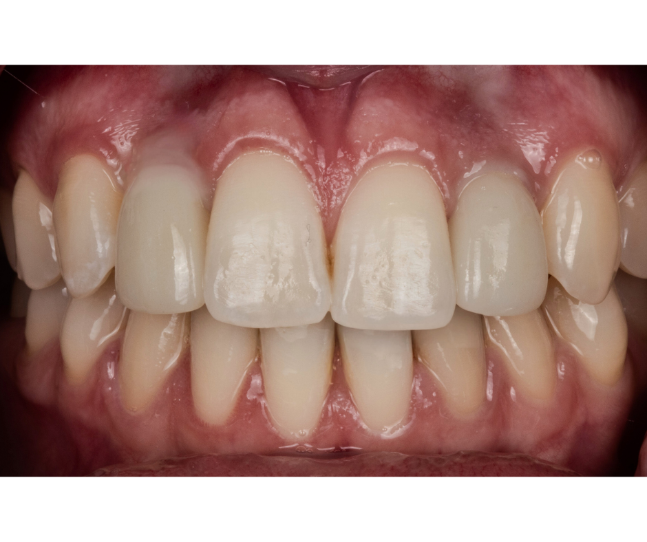 Anterior Aesthetic Rehabilitation, After