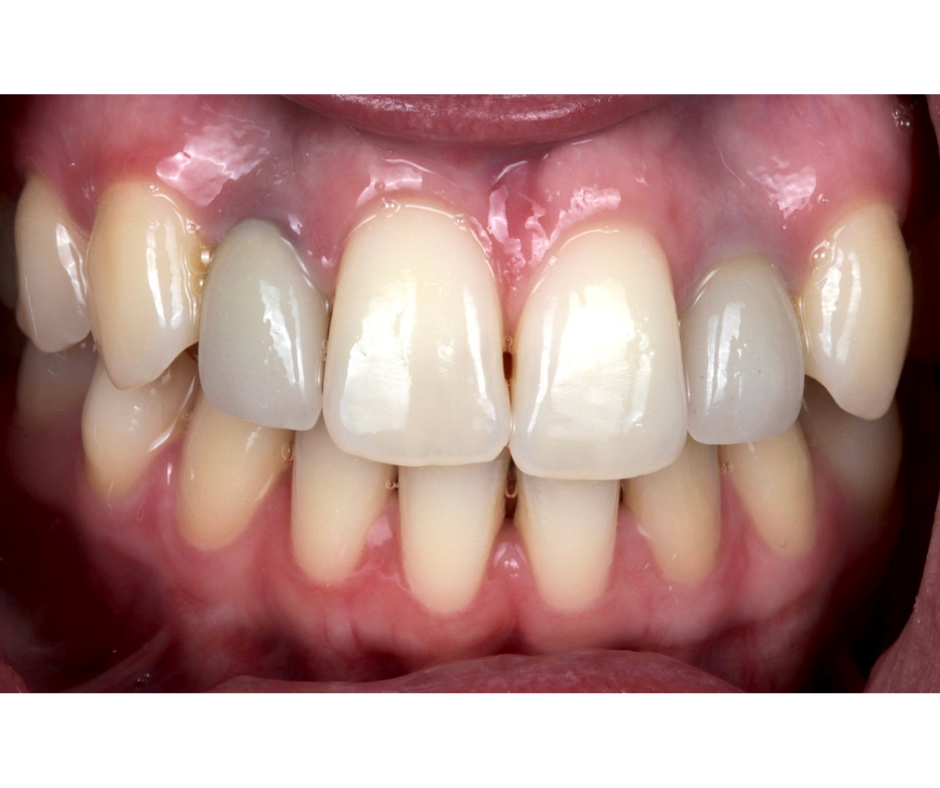 Anterior Aesthetic Rehabilitation, Before