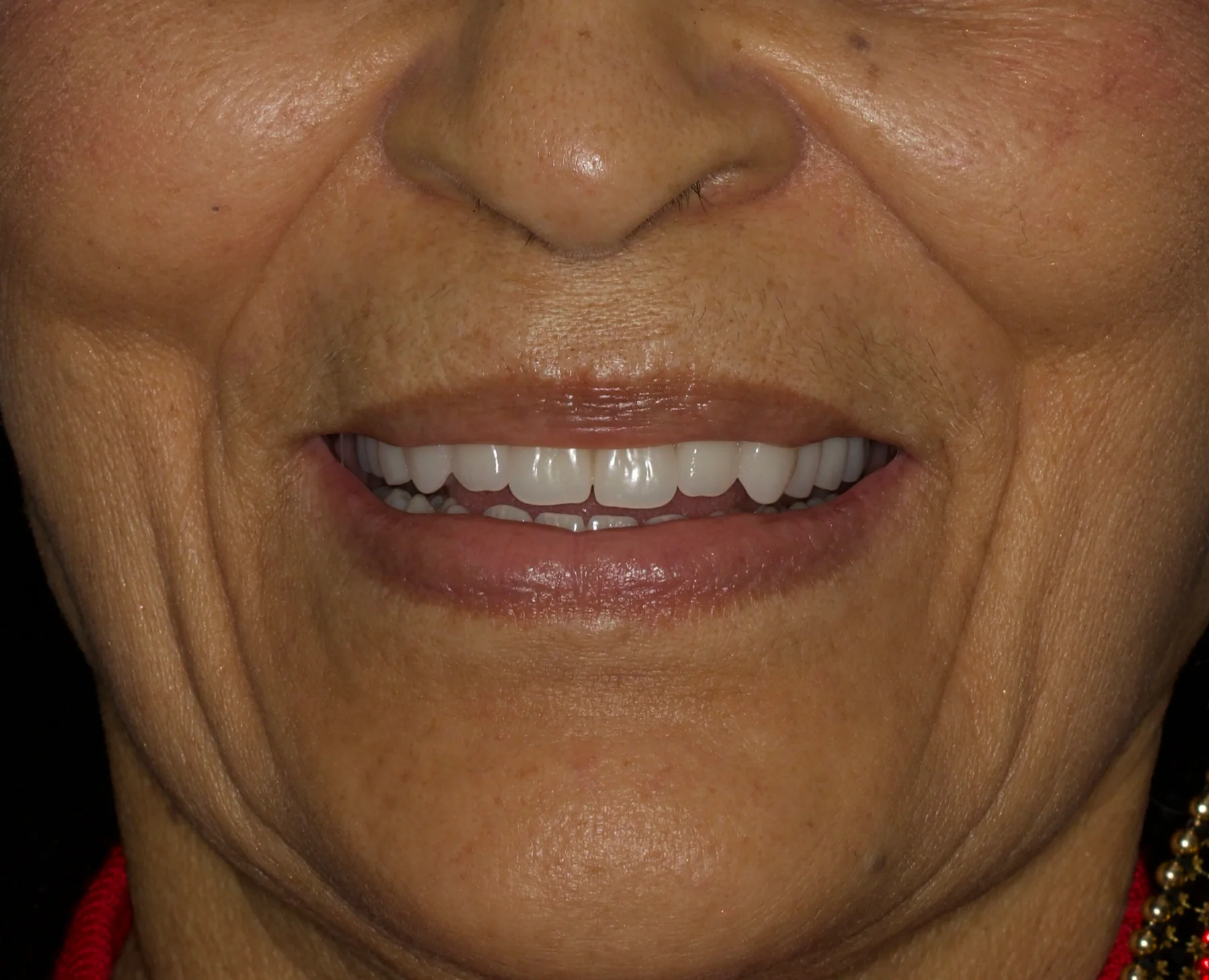After dual-arch All-on-4 treatment showing fixed implant-supported teeth