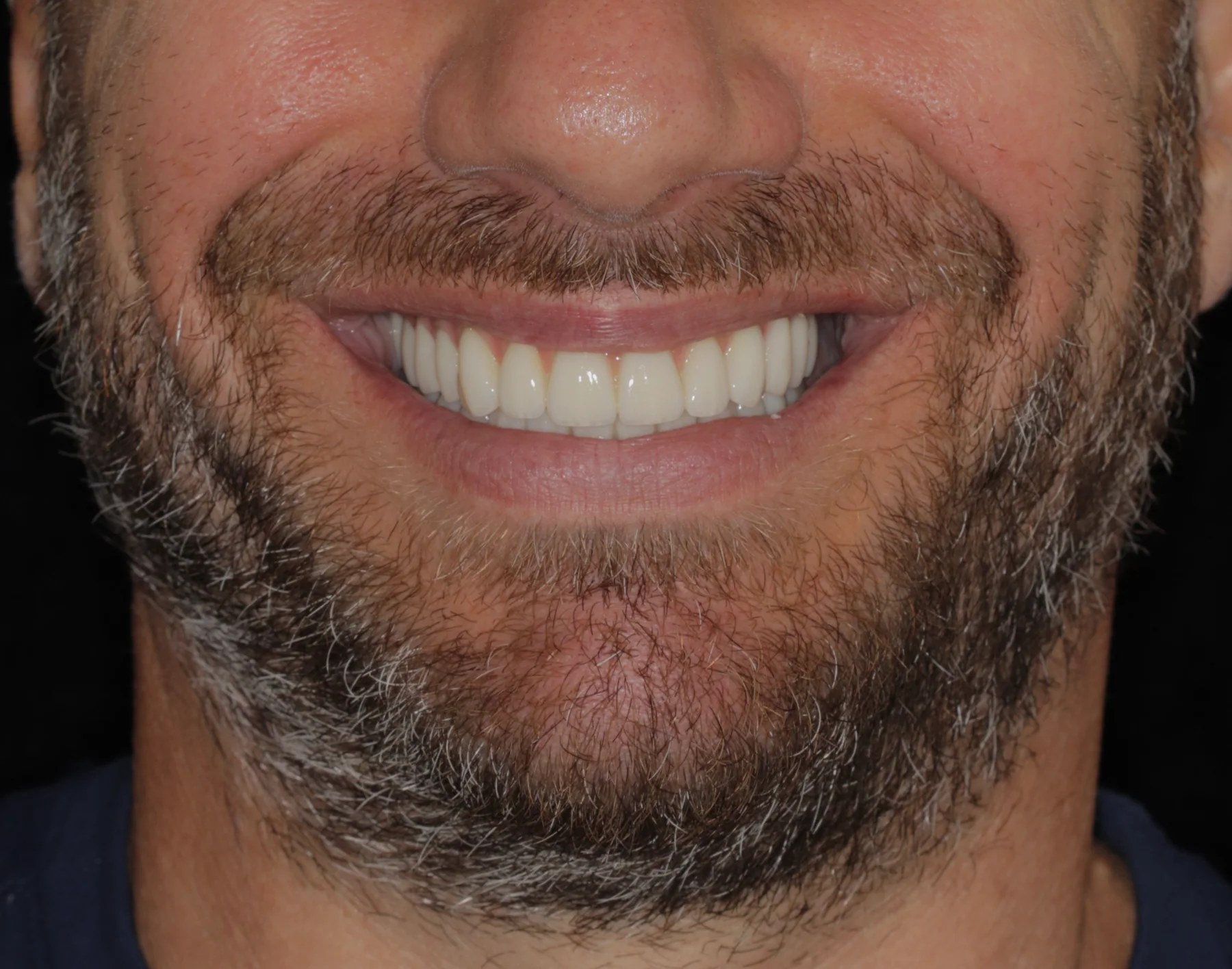 After dual-arch All-on-4 rehabilitation showing fixed upper and lower implant-supported teeth