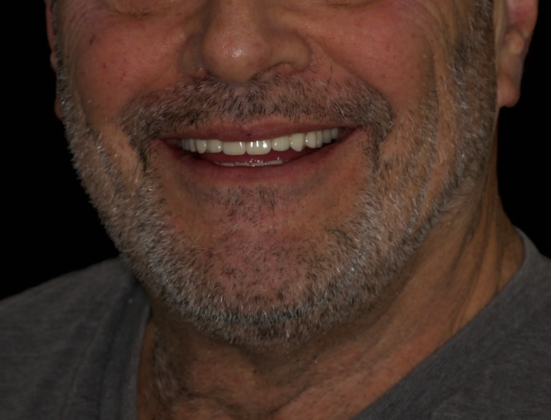 After upper and lower All-on-4 rehabilitation showing a restored fixed smile