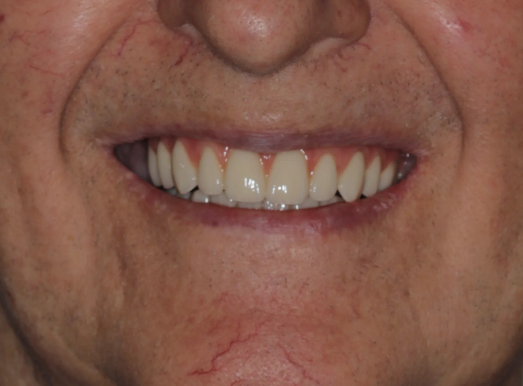 After dual-arch All-on-6 rehabilitation showing fixed upper and lower implant-supported teeth