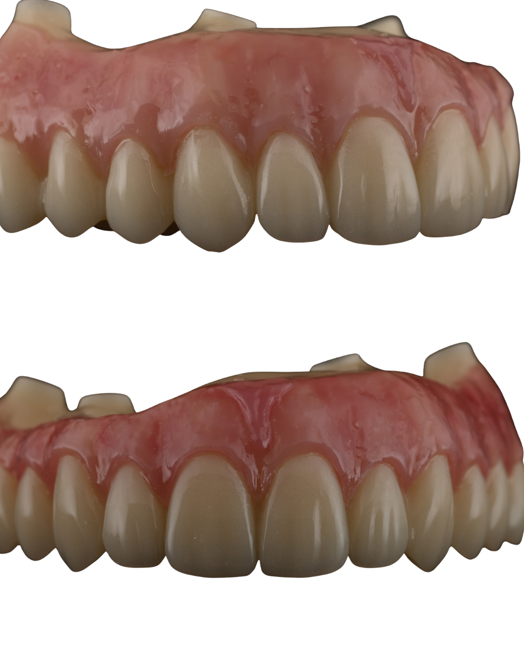 Full arch implant prosthesis showcasing precision craftsmanship