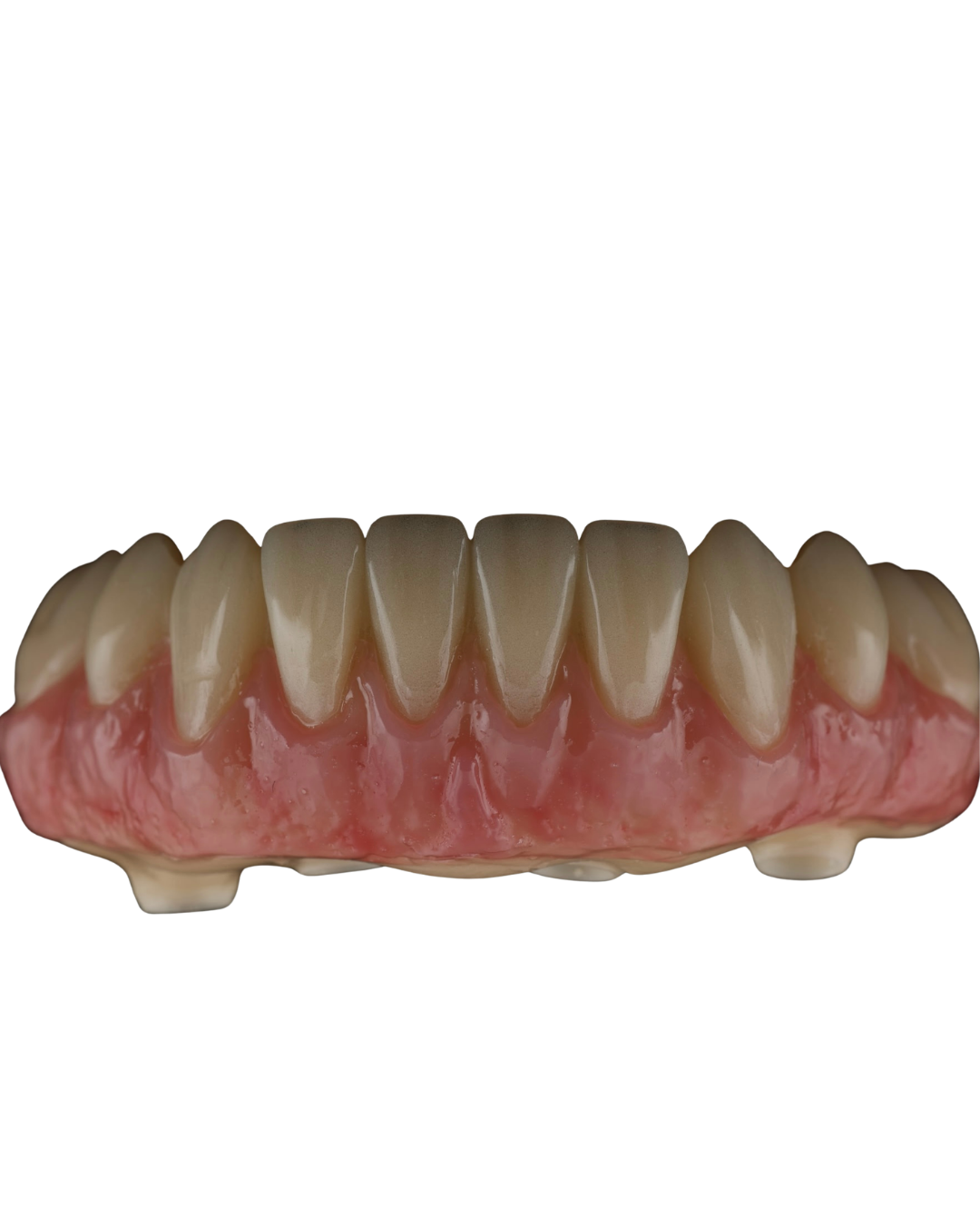 Full arch lower implant prosthesis with natural tissue detail