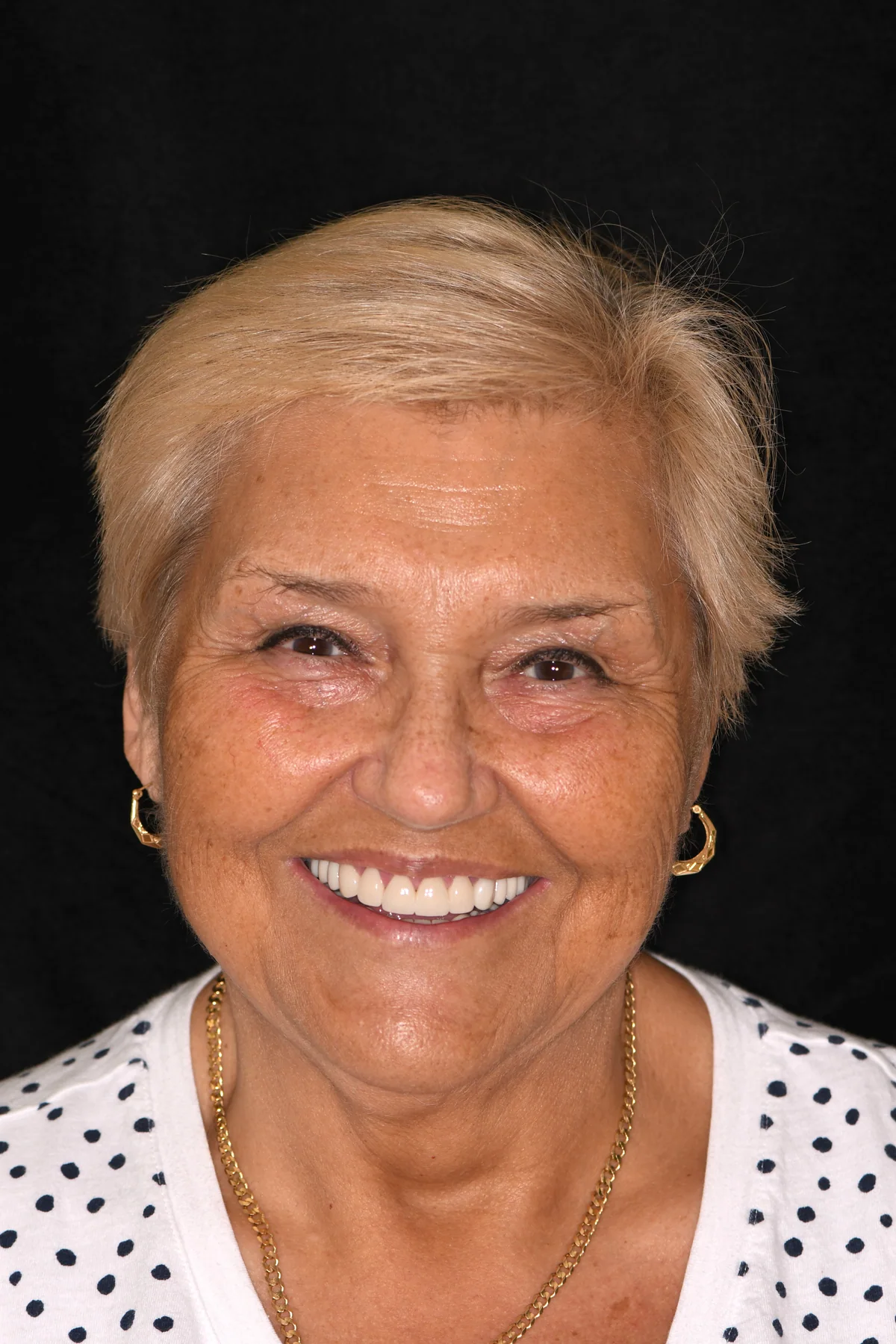 After full-mouth rehabilitation with implants and crowns showing restored tooth form and bite support