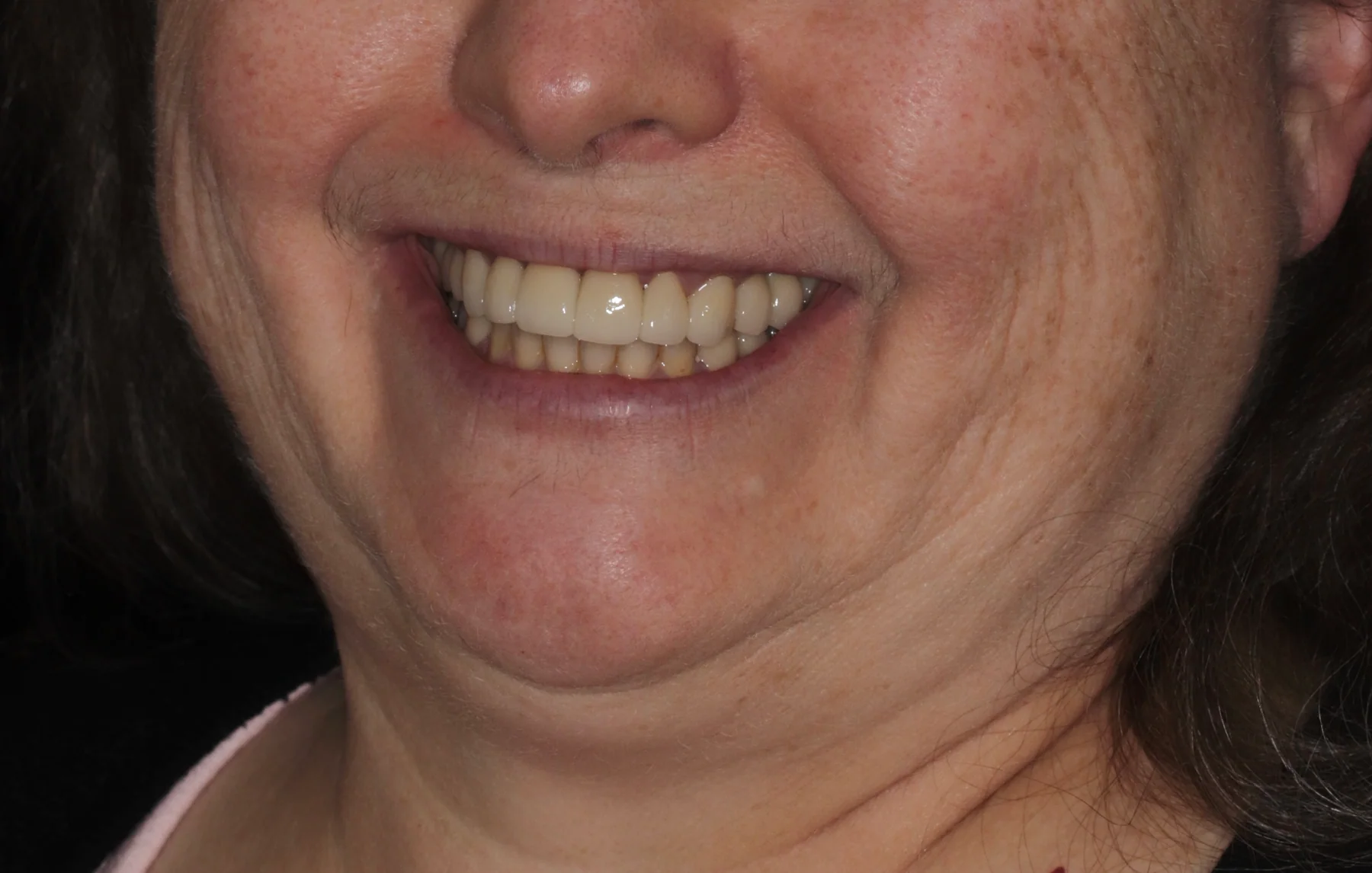After full-mouth reconstruction with implants and crowns showing restored tooth form and function
