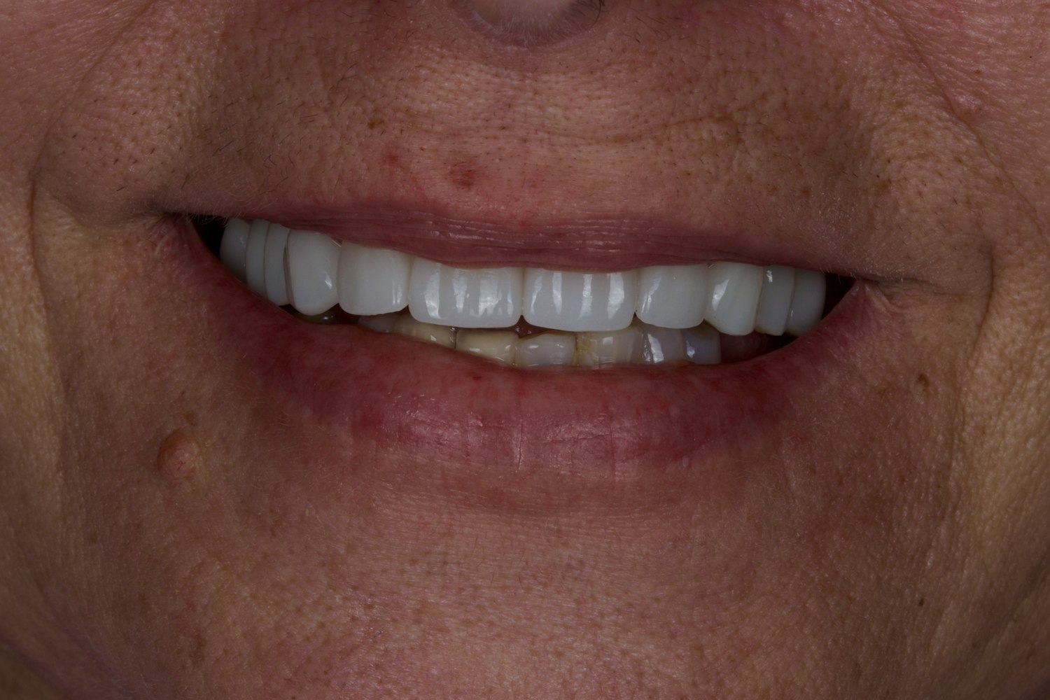 Full-mouth rehabilitation case, after treatment