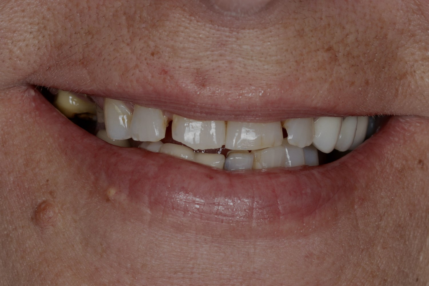 Full-mouth rehabilitation case, before treatment