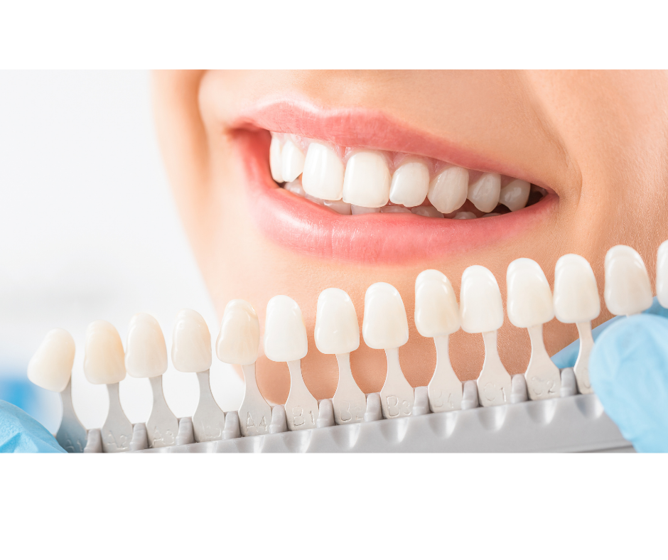 Professional shade guide for teeth whitening