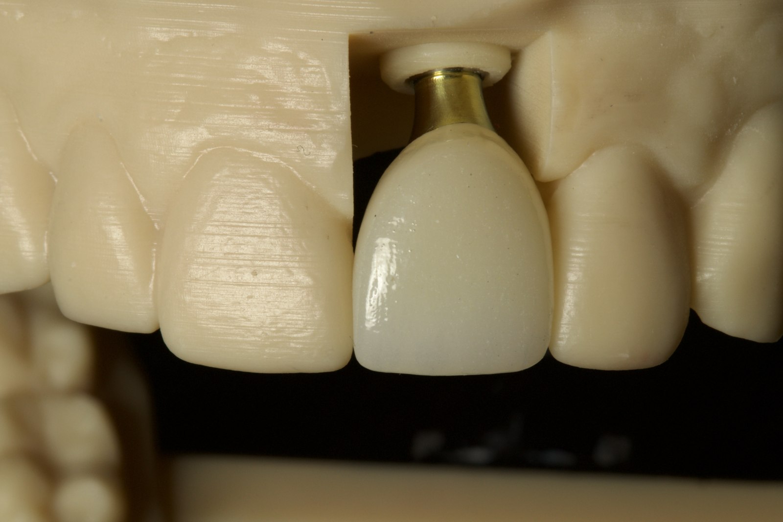Same-Day Implants