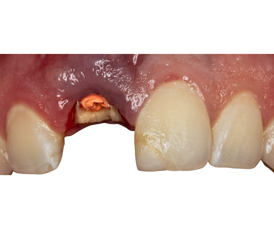 Immediate Implants — before treatment