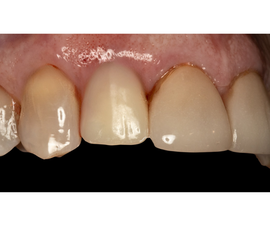 Same-Day Implants