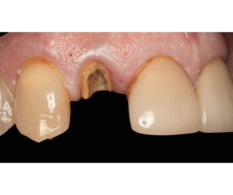 Case 2, before immediate implant placement