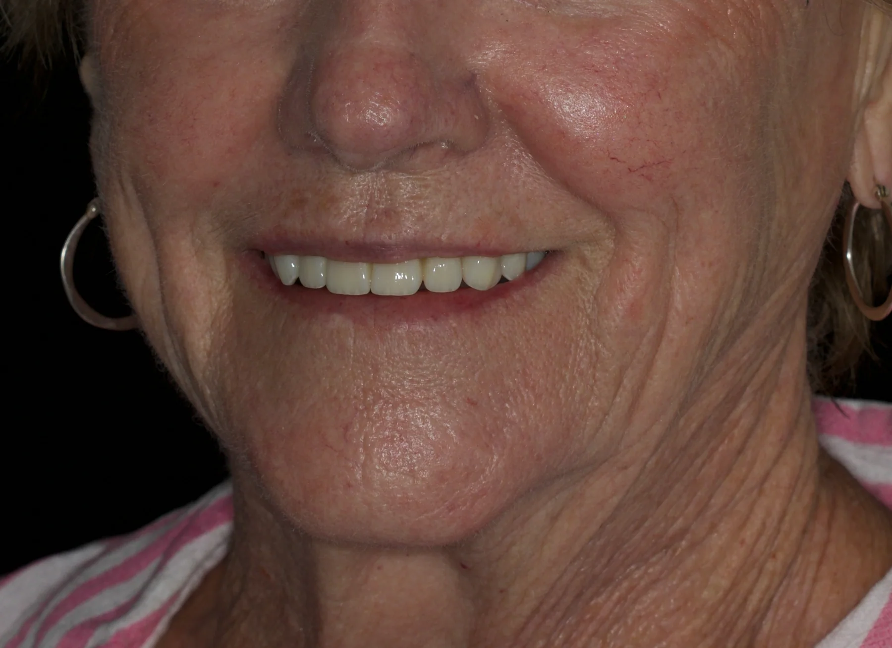 After maxillary All-on-4 rehabilitation showing fixed upper implant-supported teeth