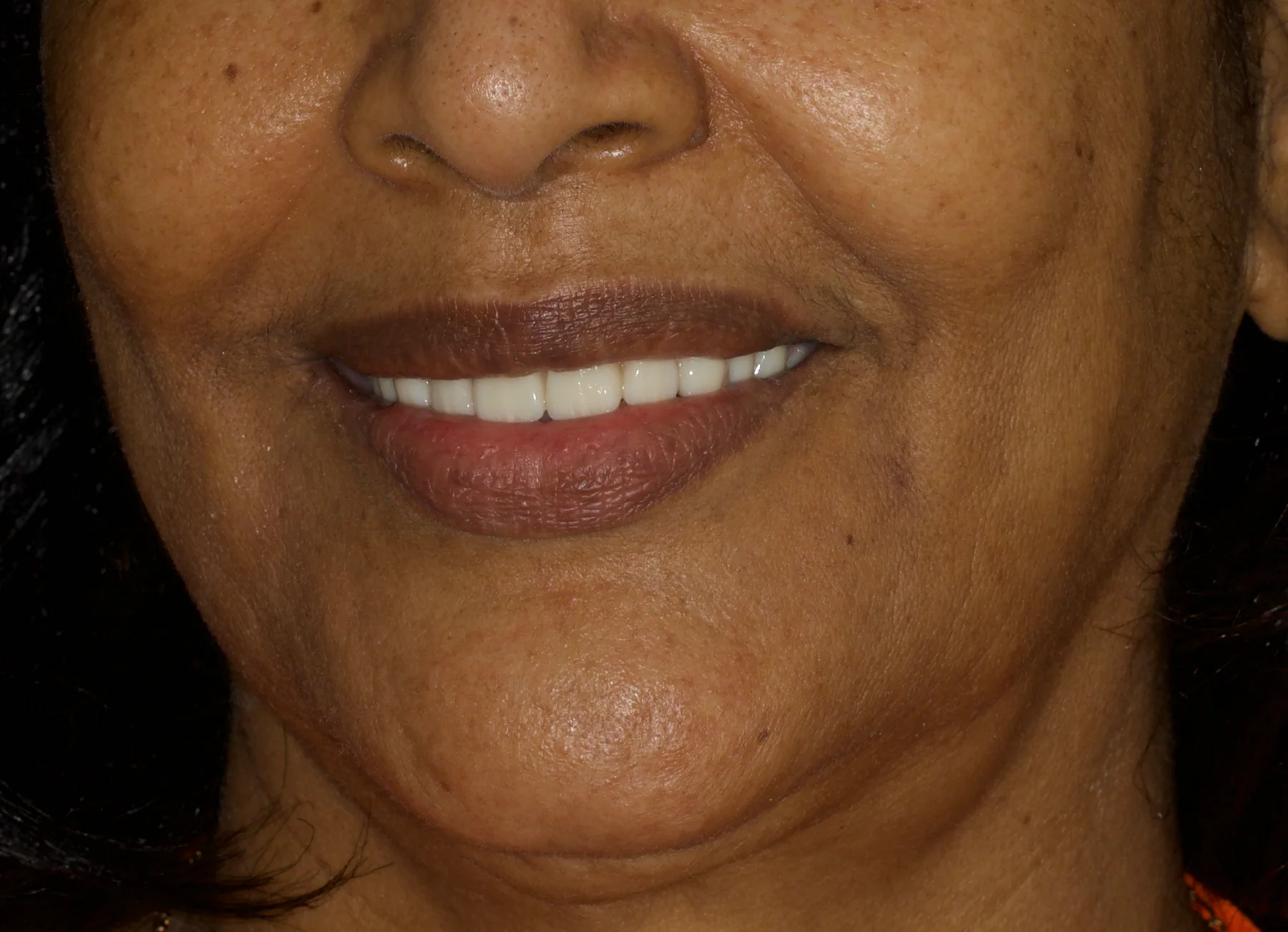 After maxillary All-on-6 rehabilitation showing fixed upper implant-supported teeth