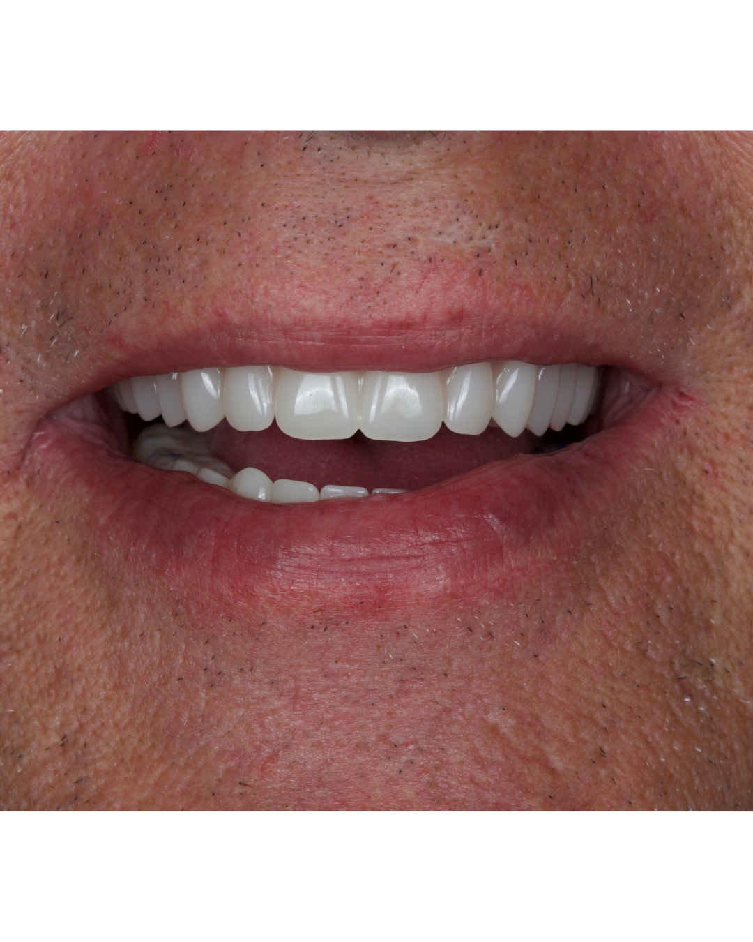 Full-Mouth Reconstruction