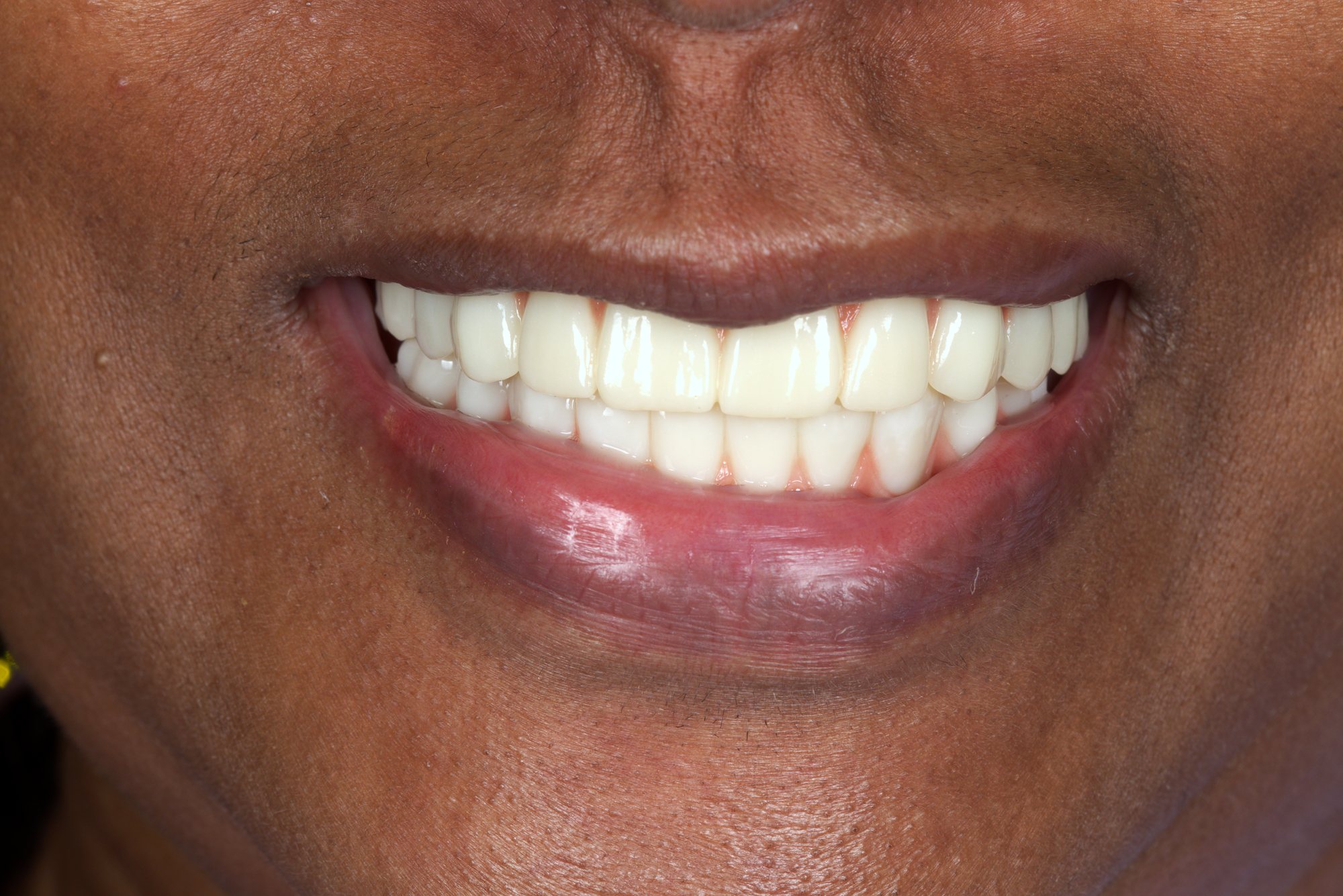 Full Upper & Lower Rehabilitation — result
