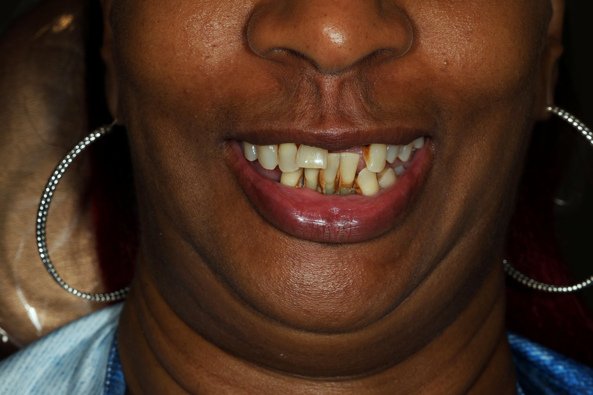 Full Upper & Lower Rehabilitation — before treatment