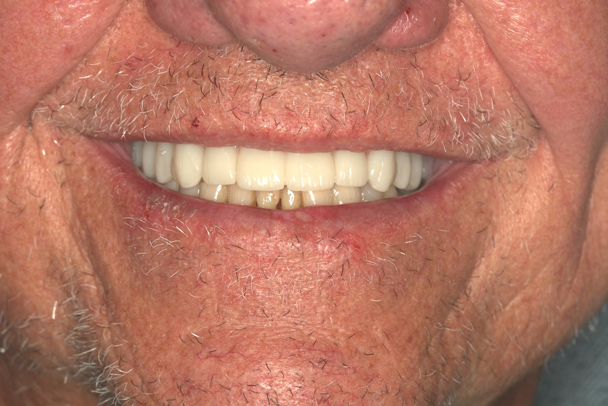 Complete Arch Reconstruction — result
