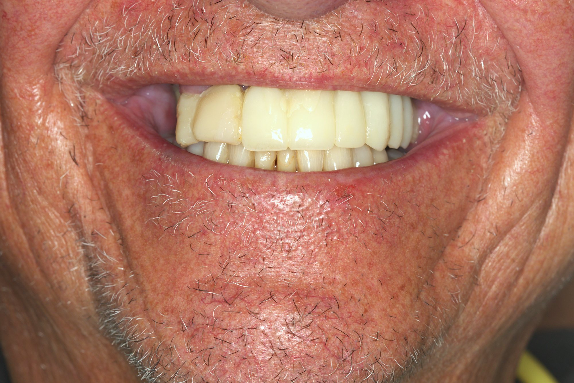 Complete Arch Reconstruction — before treatment