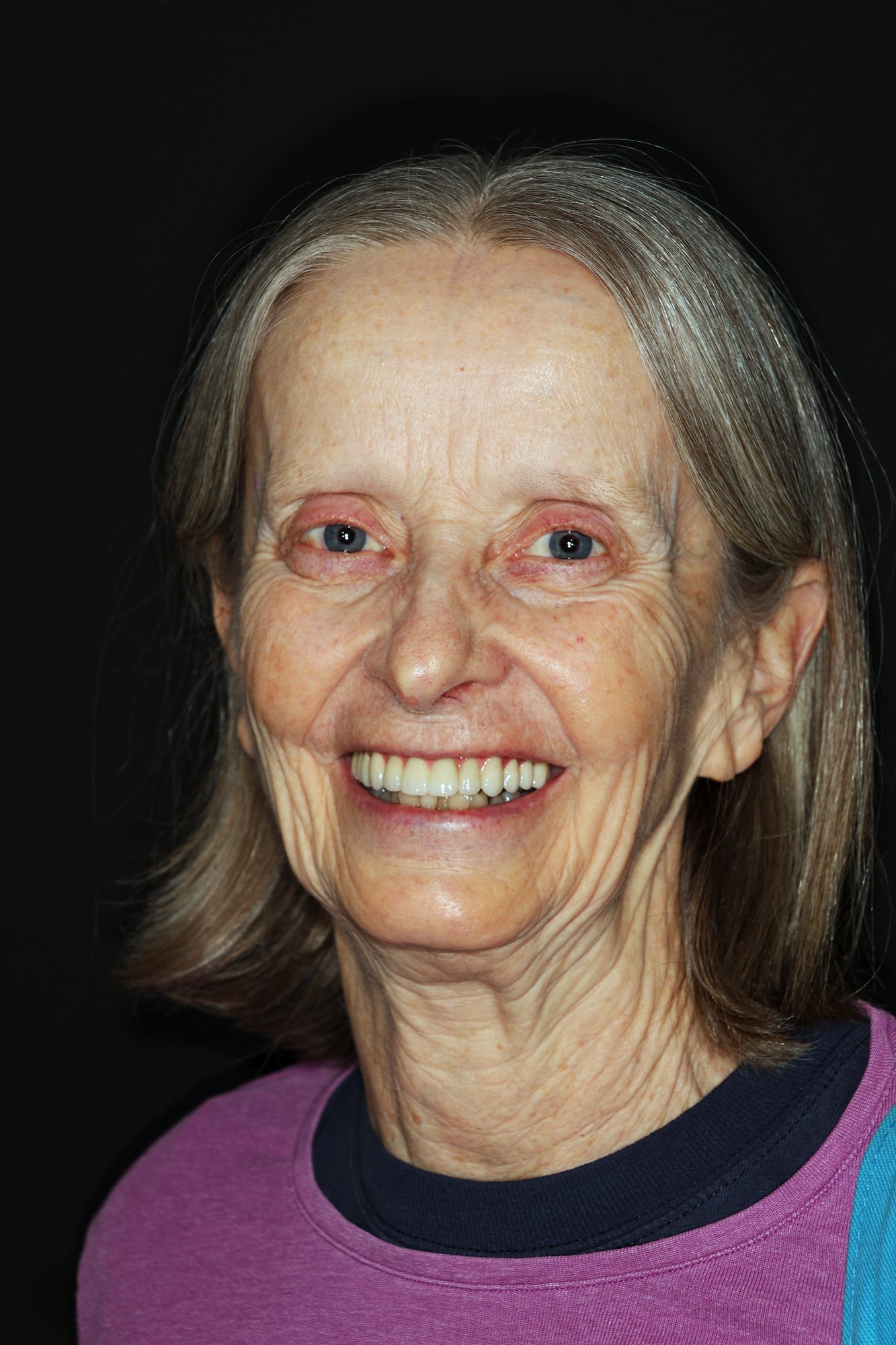 Complete Smile Rehabilitation, after treatment
