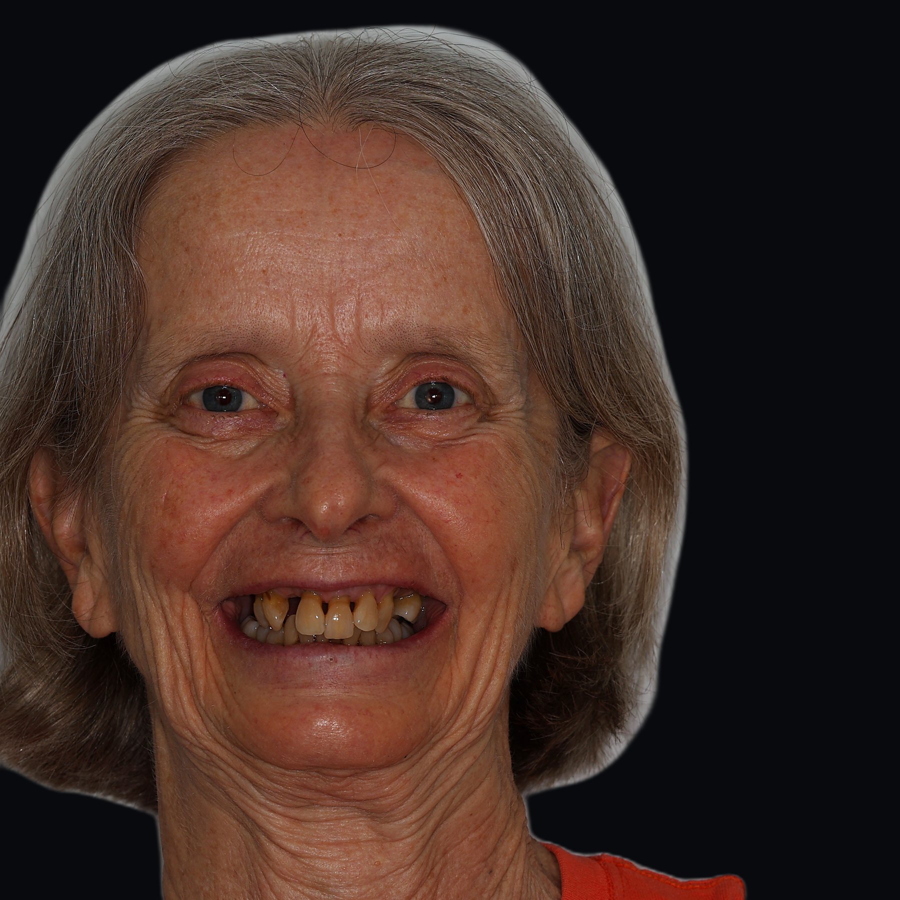 Complete Smile Rehabilitation, before treatment