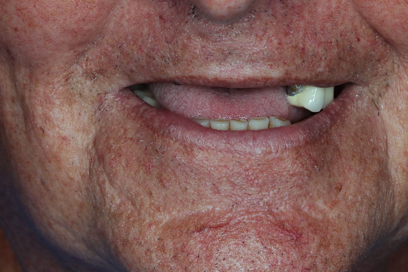 Complete Upper Restoration — before treatment