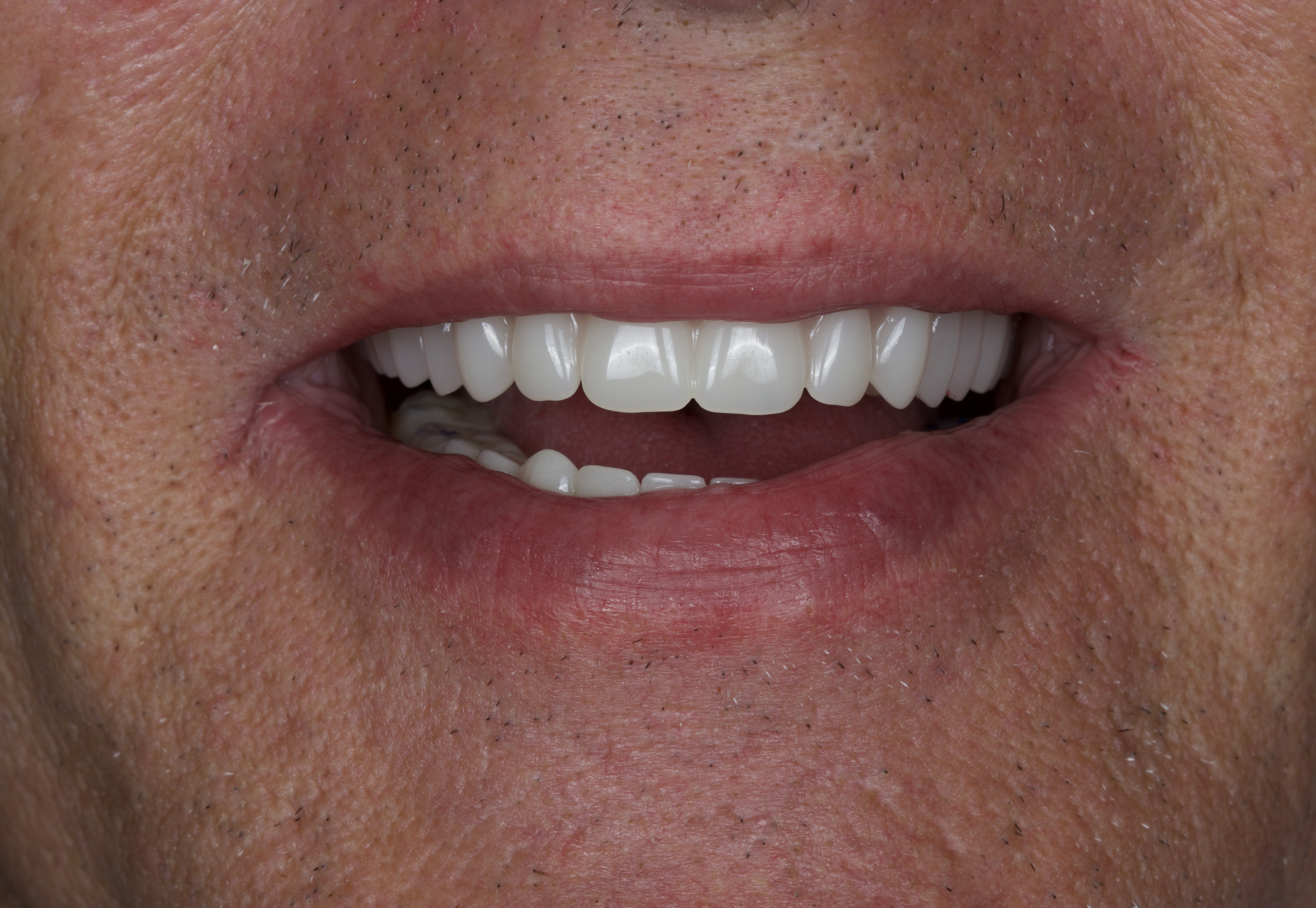 Failing Dentition, Rebuilt, result