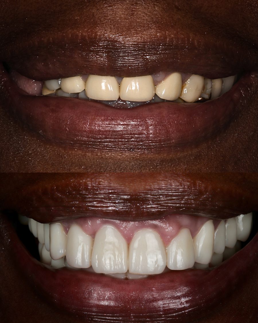 Worn, discoloured and chipped front teeth before treatment, and the same teeth rebuilt to a full, even smile after bite reconstruction