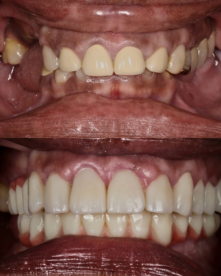 Shortened, worn upper front teeth before treatment, and a full arch of natural-looking restorations after full mouth rebuild