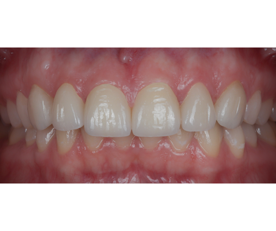 Porcelain Veneers — result