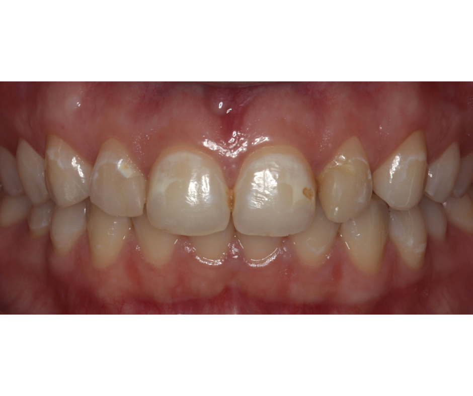 Porcelain Veneers — before treatment