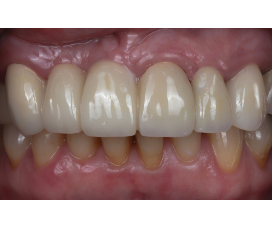 Veneers & Smile Design — result