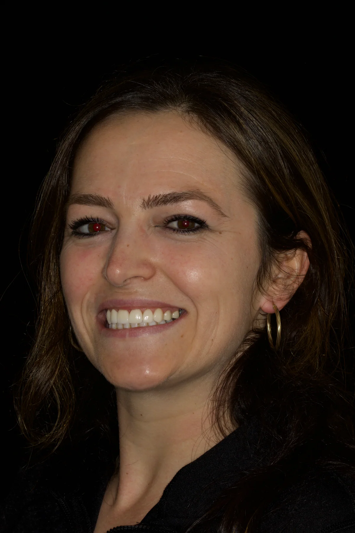 After canine-to-canine veneers and crowns showing aligned natural-looking front teeth